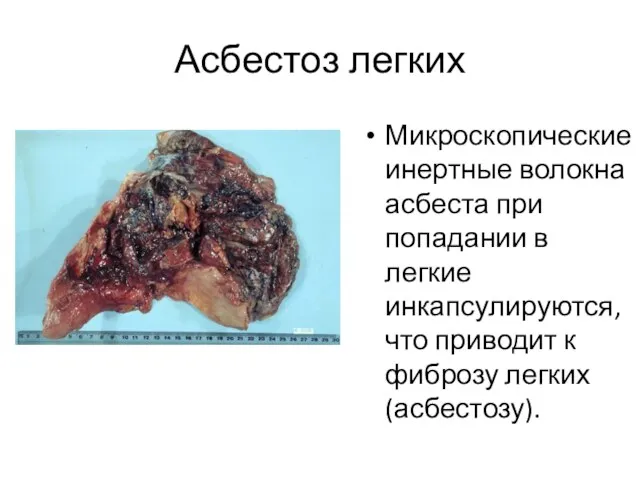 Асбестоз легких Микроскопические инертные волокна асбеста при попадании в легкие