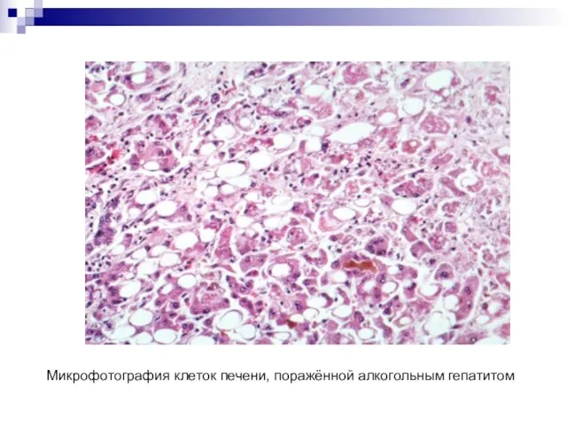 Микрофотография клеток печени, поражённой алкогольным гепатитом