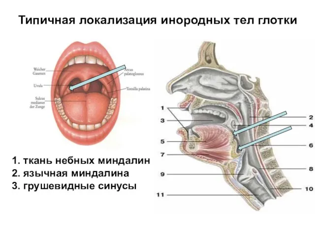 Типичная локализация инородных тел глотки 1. ткань небных миндалин 2. язычная миндалина 3. грушевидные синусы