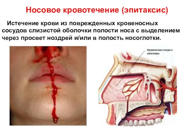 Истечение крови из поврежденных кровеносных сосудов слизистой оболочки полости носа