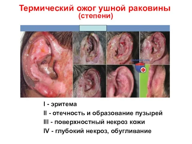 Термический ожог ушной раковины (степени) I - эритема II -