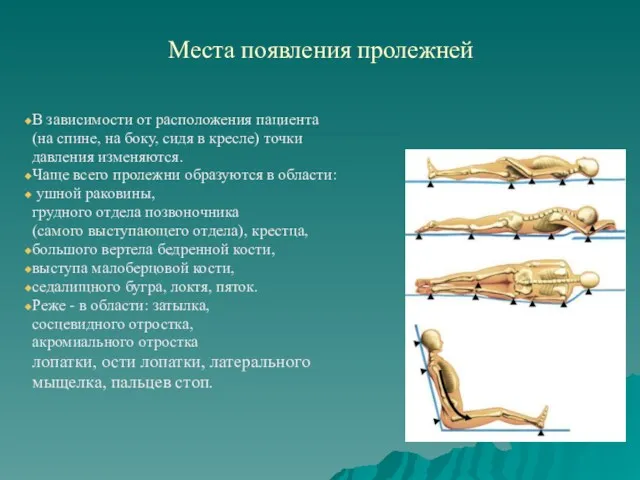 Места появления пролежней В зависимости от расположения пациента (на спине, на боку, сидя