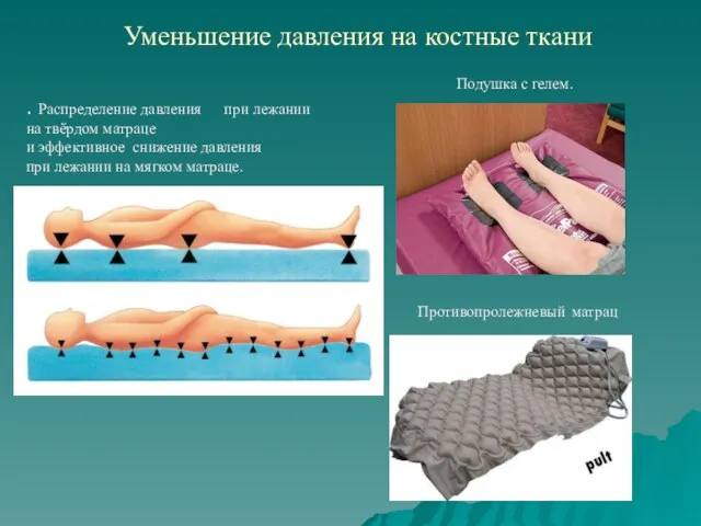 Уменьшение давления на костные ткани Подушка с гелем. Противопролежневый матрац . Распределение давления