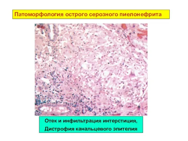 Патоморфология острого серозного пиелонефрита Отек и инфильтрация интерстиция, Дистрофия канальцевого эпителия