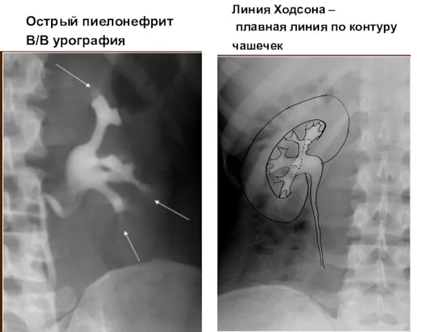 Острый пиелонефрит В/В урография Линия Ходсона – плавная линия по контуру чашечек