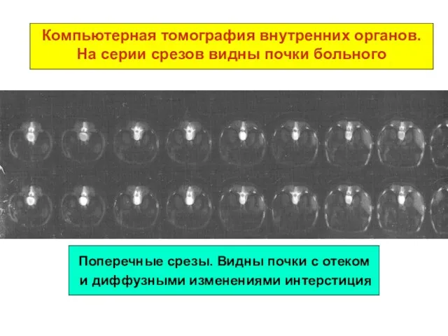 Компьютерная томография внутренних органов. На серии срезов видны почки больного Поперечные срезы. Видны