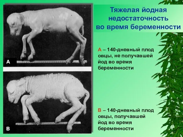 Тяжелая йодная недостаточность во время беременности А – 140-дневный плод