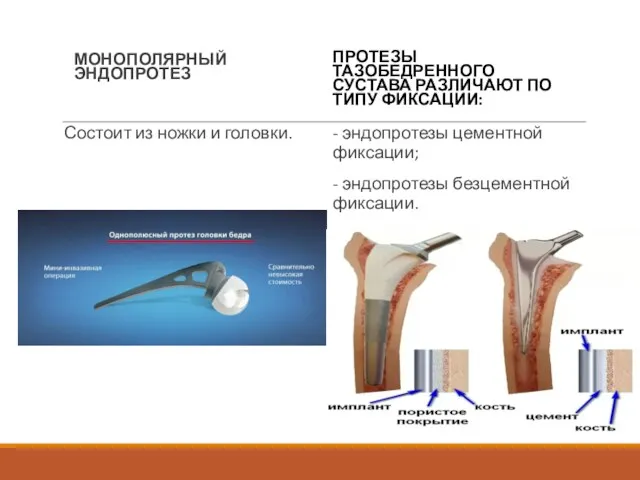 МОНОПОЛЯРНЫЙ ЭНДОПРОТЕЗ Состоит из ножки и головки. ПРОТЕЗЫ ТАЗОБЕДРЕННОГО СУСТАВА РАЗЛИЧАЮТ ПО ТИПУ