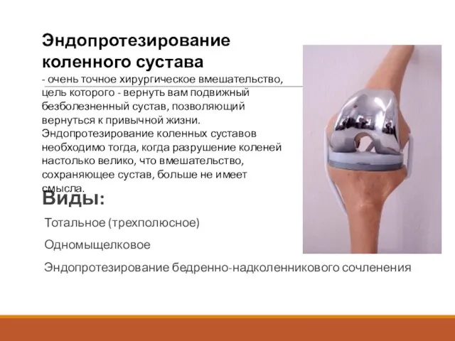 Виды: Тотальное (трехполюсное) Одномыщелковое Эндопротезирование бедренно-надколенникового сочленения Эндопротезирование коленного сустава - очень точное