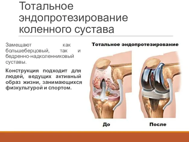 Тотальное эндопротезирование коленного сустава Замещают как большеберцовый, так и бедренно-надколенниковый суставы. Конструкция подходит