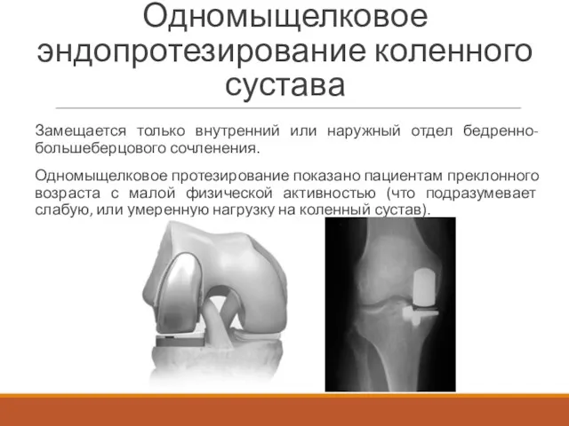 Одномыщелковое эндопротезирование коленного сустава Замещается только внутренний или наружный отдел бедренно-большеберцового сочленения. Одномыщелковое