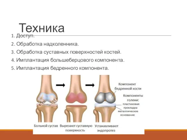 Техника 1. Доступ. 2. Обработка надколенника. 3. Обработка суставных поверхностей