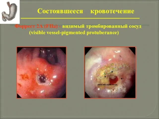 Состоявшееся кровотечение Форрест 2А (FIIa) - видимый тромбированный сосуд (visible vessel-pigmented protuberance)