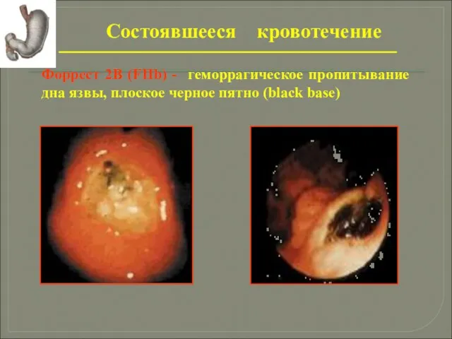 Состоявшееся кровотечение Форрест 2В (FIIb) - геморрагическое пропитывание дна язвы, плоское черное пятно (black base)