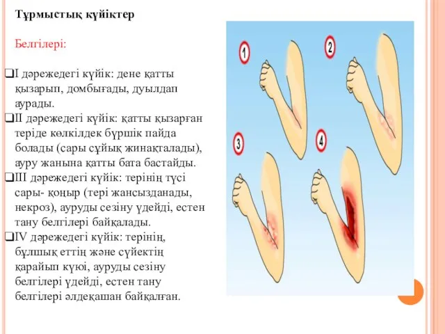 Тұрмыстық күйіктер Белгілері: І дәрежедегі күйік: дене қатты қызарып, домбығады,