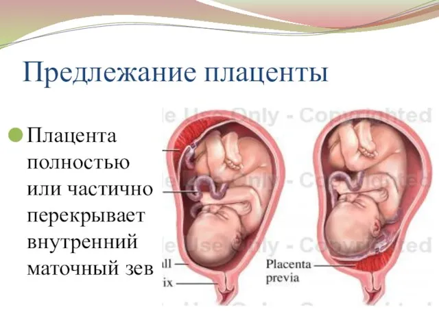 Предлежание плаценты Плацента полностью или частично перекрывает внутренний маточный зев
