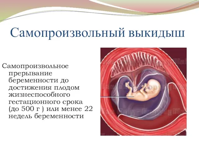 Самопроизвольный выкидыш Самопроизвольное прерывание беременности до достижения плодом жизнеспособного гестационного срока (до 500