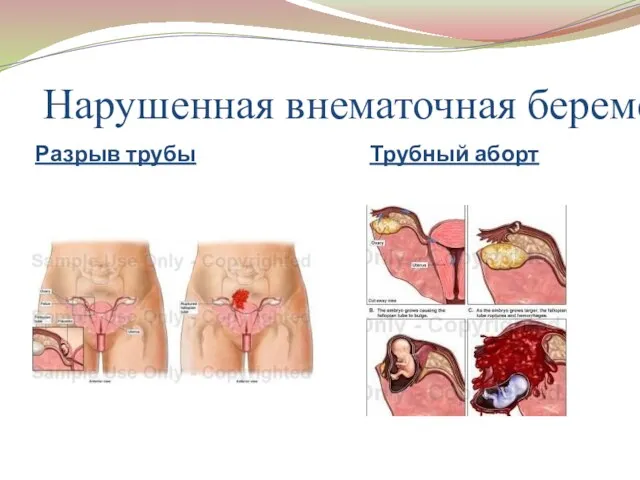 Нарушенная внематочная беременность Разрыв трубы Трубный аборт
