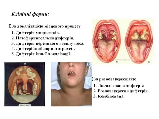 Клінічні форми: За локалізацією місцевого процесу 1. Дифтерія мигдаликів. 2.