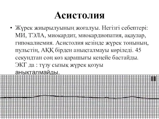 Асистолия Жүрек жиырылуының жоғалуы. Негізгі себептері: МИ, ТЭЛА, миокардит, миокардиопатия,