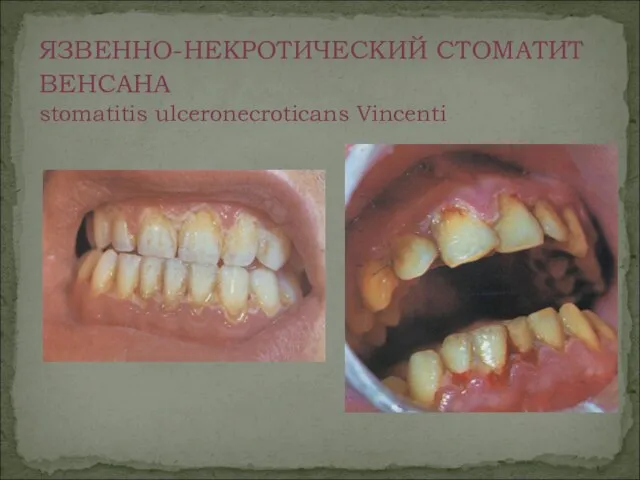 ЯЗВЕННО-НЕКРОТИЧЕСКИЙ СТОМАТИТ ВЕНСАНА stomatitis ulceronecroticans Vincenti