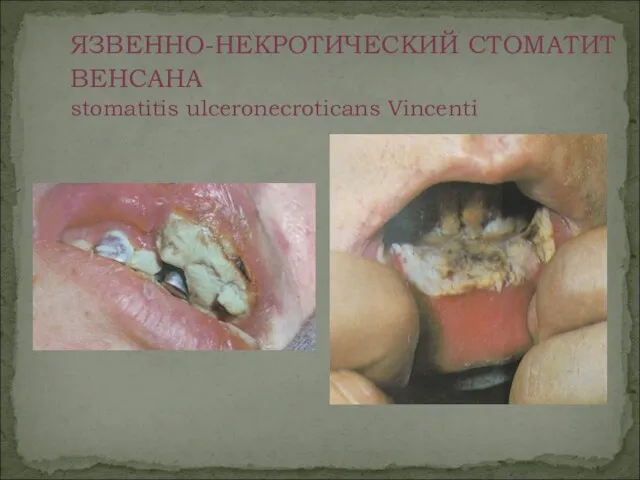 ЯЗВЕННО-НЕКРОТИЧЕСКИЙ СТОМАТИТ ВЕНСАНА stomatitis ulceronecroticans Vincenti