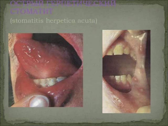 ОСТРЫЙ ГЕРПЕТИЧЕСКИЙ СТОМАТИТ (stomatitis herpetica асutа)