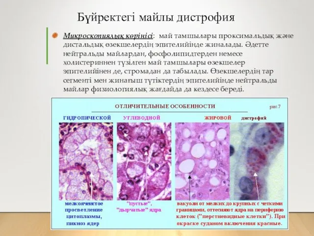 Бүйректегі майлы дистрофия Микроскопиялық көрінісі: май тамшылары проксимальдық және дистальдық өзекшелердің эпителийінде жиналады.