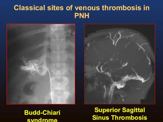 Budd-Chiari syndrome Superior Sagittal Sinus Thrombosis Classical sites of venous thrombosis in PNH