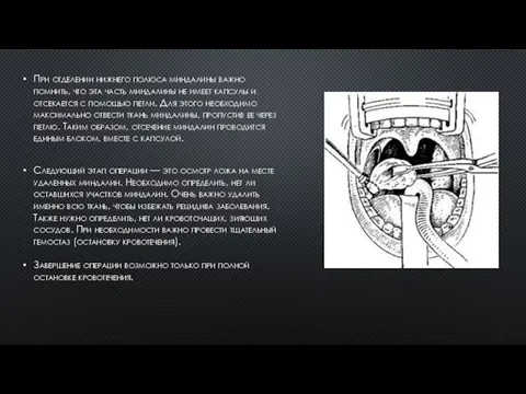 При отделении нижнего полюса миндалины важно помнить, что эта часть миндалины не имеет