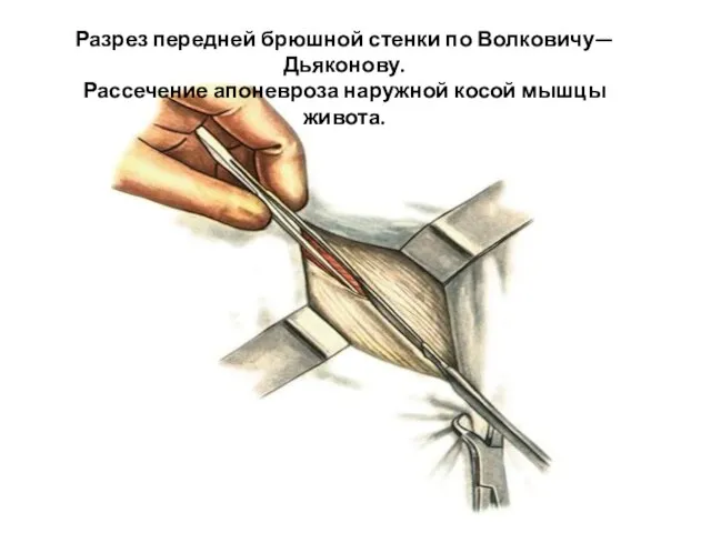 Разрез передней брюшной стенки по Волковичу—Дьяконову. Рассечение апоневроза наружной косой мышцы живота.