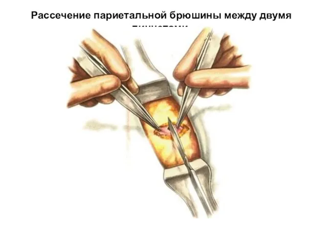 Рассечение париетальной брюшины между двумя пинцетами.