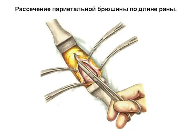 Рассечение париетальной брюшины по длине раны.