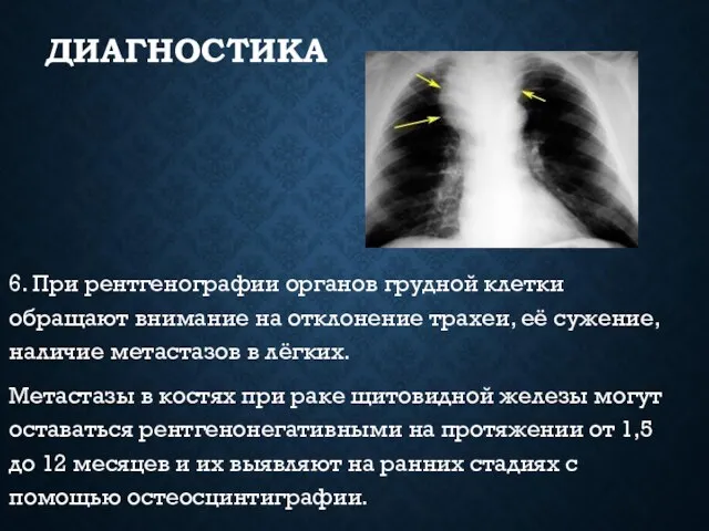 ДИАГНОСТИКА 6. При рентгенографии органов грудной клетки обращают внимание на