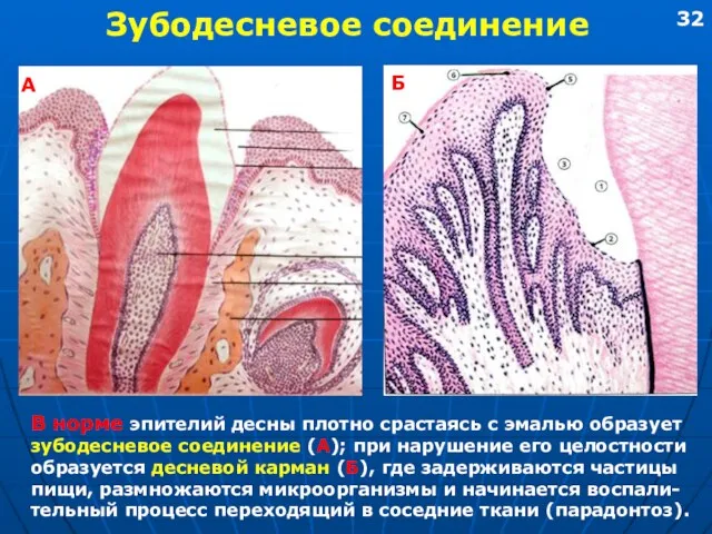 Зубодесневое соединение В норме эпителий десны плотно срастаясь с эмалью