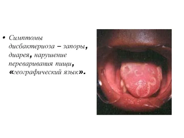 Симптомы дисбактериоза – запоры, диарея, нарушение переваривания пищи, «географический язык».