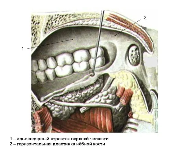 1 1 – альвеолярный отросток верхней челюсти 2 – горизонтальная пластинка нёбной кости 2