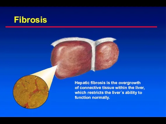 Fibrosis Hepatic fibrosis is the overgrowth of connective tissue within
