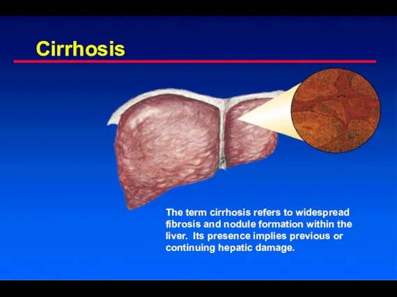 Cirrhosis The term cirrhosis refers to widespread fibrosis and nodule