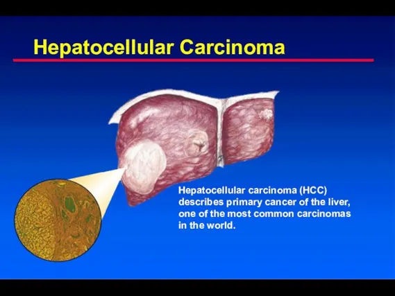 Hepatocellular Carcinoma Hepatocellular carcinoma (HCC) describes primary cancer of the