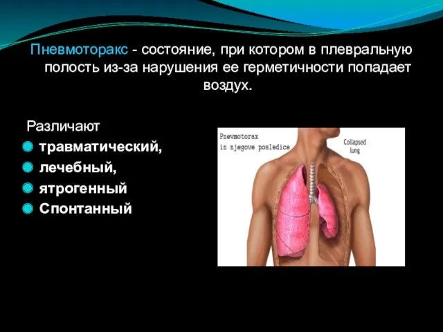 Пневмоторакс - состояние, при котором в плевральную полость из-за нарушения