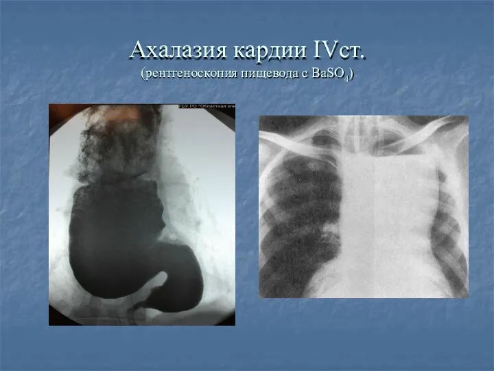 Ахалазия кардии IVст. (рентгеноскопия пищевода с ВаSO4)