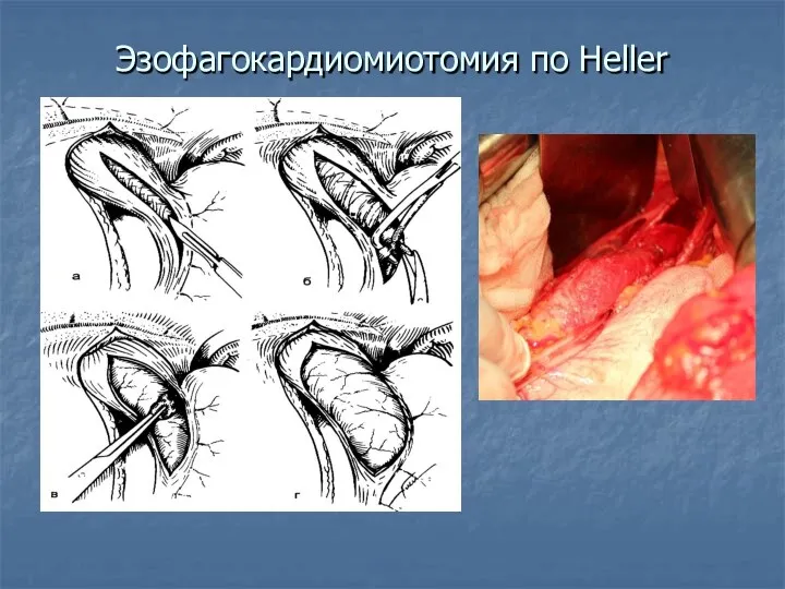 Эзофагокардиомиотомия по Heller