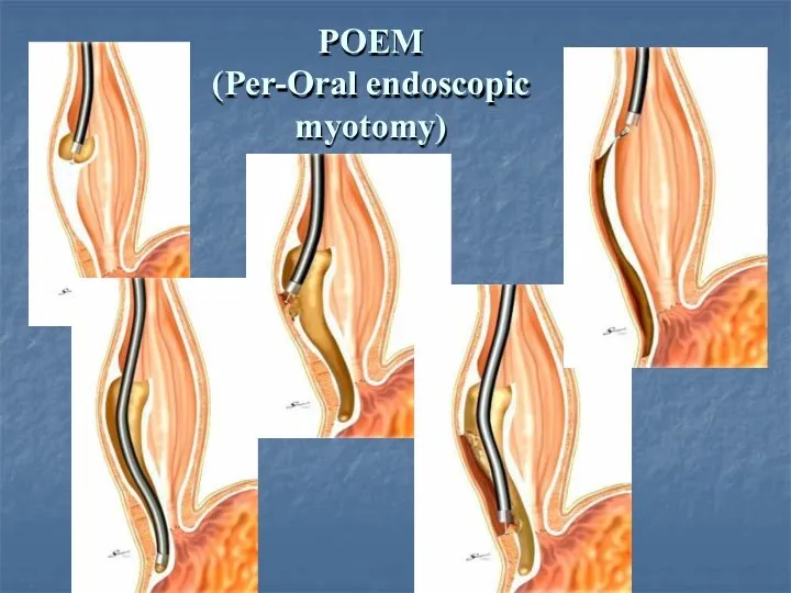 POEM (Per-Oral endoscopic myotomy)