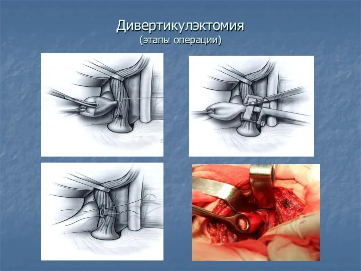 Дивертикулэктомия (этапы операции)