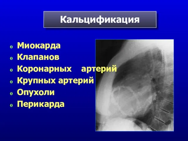 Кальцификация Миокарда Клапанов Коронарных артерий Крупных артерий Опухоли Перикарда