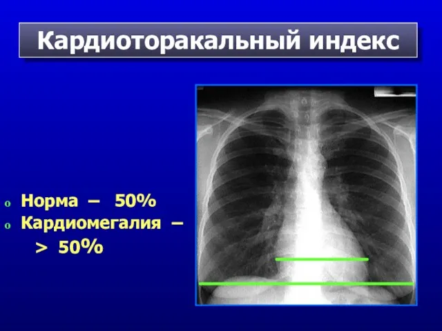 Кардиоторакальный индекс Норма – 50% Кардиомегалия – > 50%