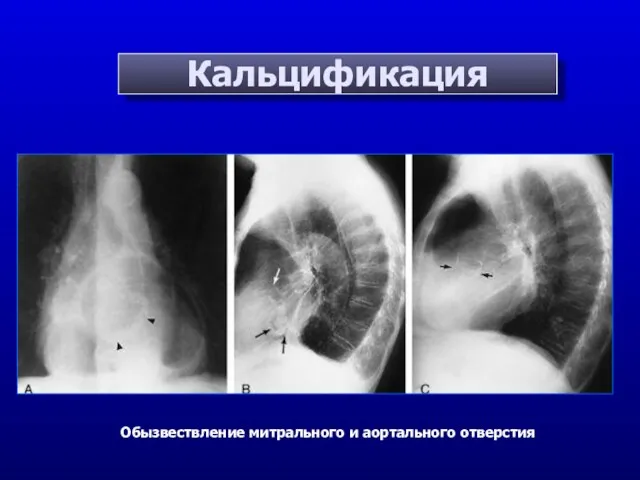 Кальцификация Обызвествление митрального и аортального отверстия