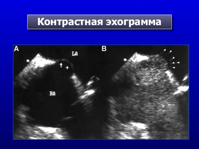 Контрастная эхограмма
