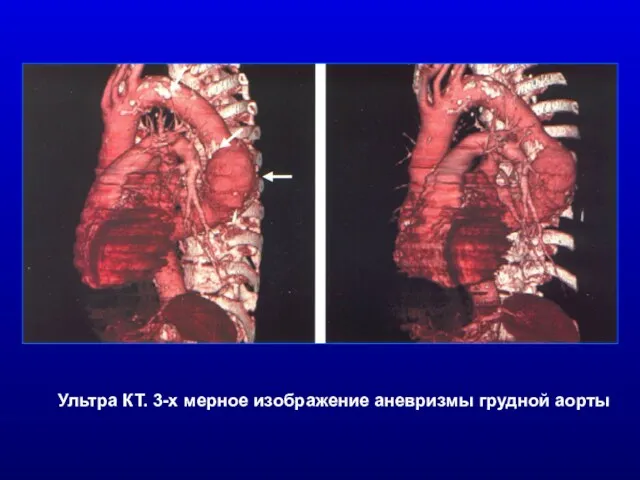 Ультра КТ. 3-х мерное изображение аневризмы грудной аорты